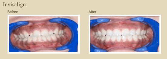 Invisalign orthodontic Treatment