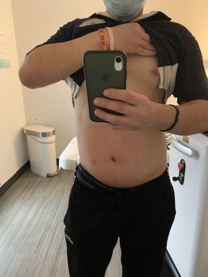 Second treatment on my stomach using the XL applicator for the first time (look at the red outline to see how much it treats).