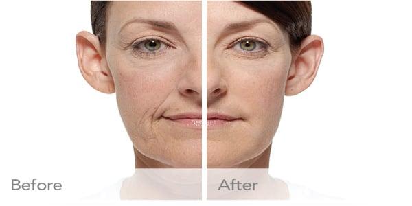 Radiesse Dermal Filler