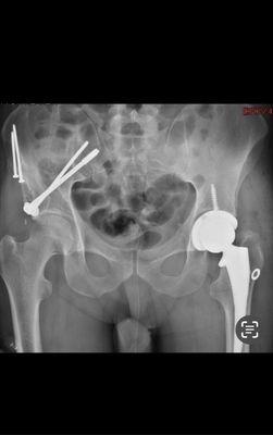 Total left hip replacement by Dr. Carlos Guanche. Very nice.