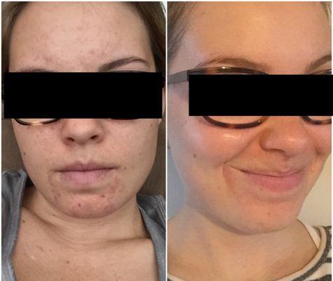 Before (left) and After (right) -- huge improvements in my skin!