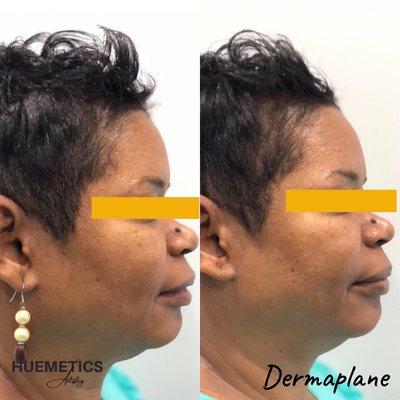 Beautiful Before & After Dermaplane Photos. 
My client also booked an Ageless Stem Cell Peptide Face & Neck Mask as Add-ons.