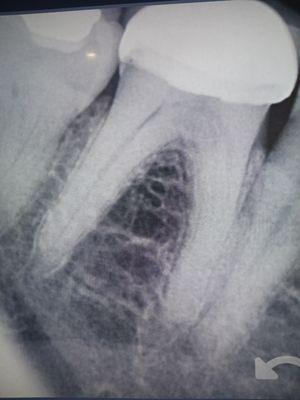 Simple x-ray of my tooth with Cap