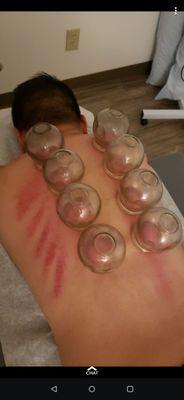 Fire cupping.