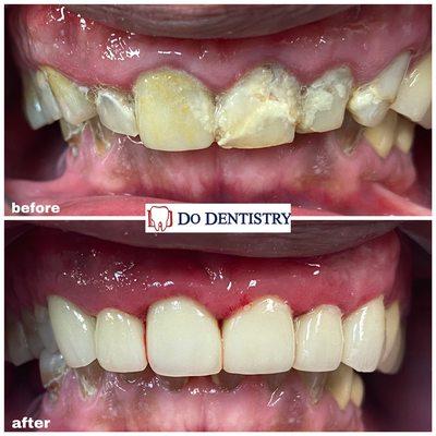 Porcelain crowns to create a new smile