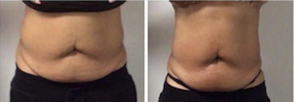 Before and After 3 Combo Treatments (Cavitation and Skin Tightening)