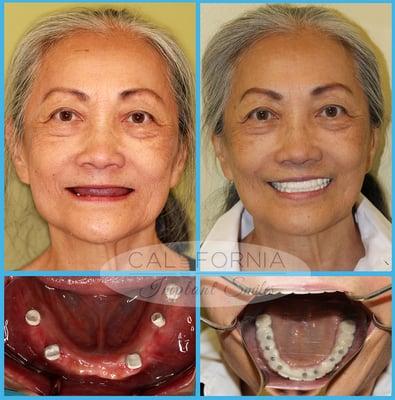 Permanent Dentures before and after client of the month.