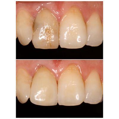 Single tooth life-like porcelain crowns