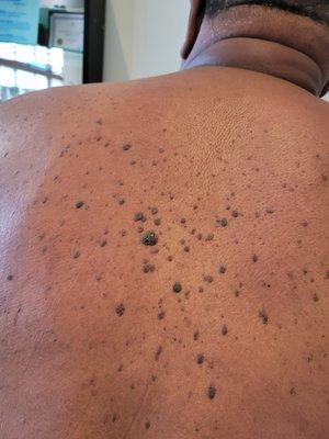 Back Skin Tag Growth Removal in Los Angeles Marina Del Rey Area.