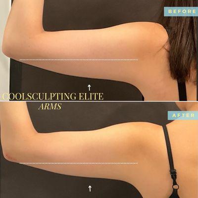 Coolsculpting Elite Arms