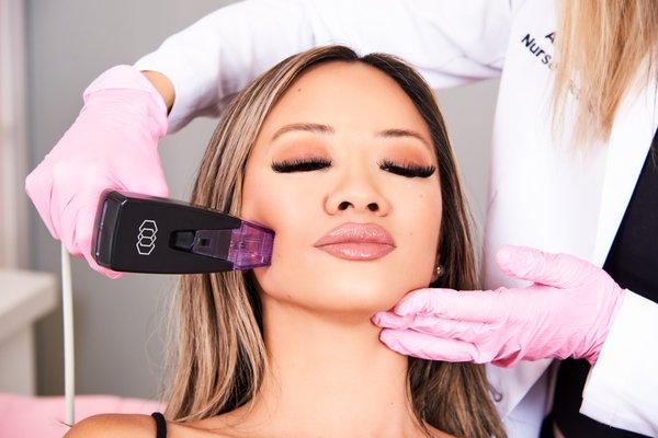 MORPHEUS8 radio frequency microneedling for skin rejuvenation, lifting, contouring, and subdermal remodeling.