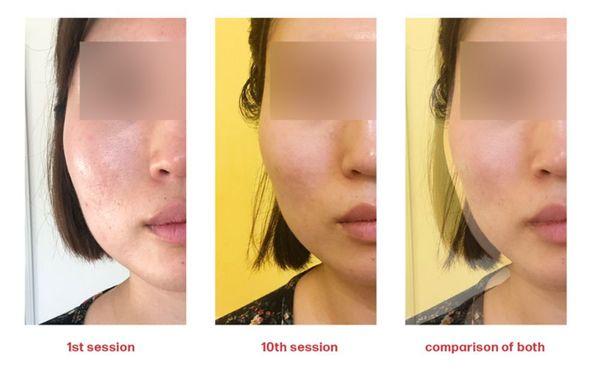 Skin meridian facial before &after 10 session