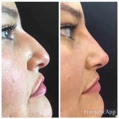 Nonsurgical Rhinoplasty done in under one hour