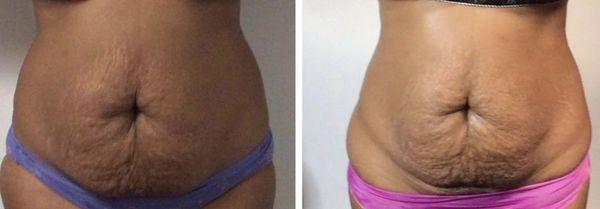 Before and After 3 Skin Tightening Treatments