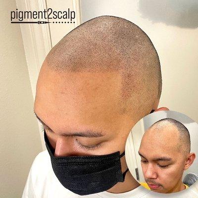 Before and after Scalp Micropigmentation (SMP) with Pigment2scalp San Diego.