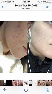 Before and After Chemical Peel Series