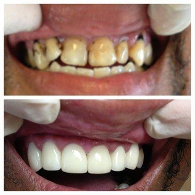 Before and After and crowns and veneers