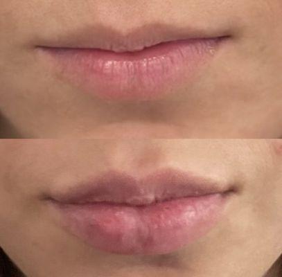 Lip filler