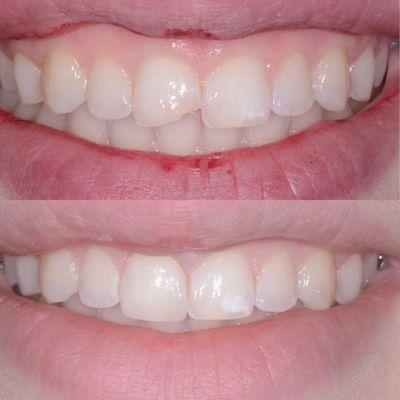 Single veneer to replace front tooth