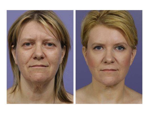 Facelift & neck lift, eyelids, and two treatments with C02 laser by Dr. David Stoker