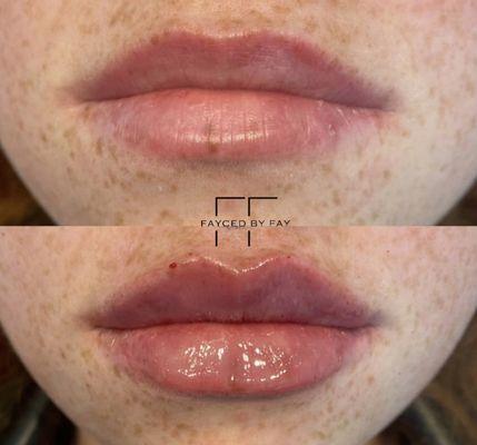 Lip Augmentation by Nurse Fay.