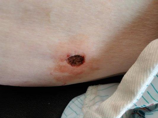 Squamous cell cancer on my thigh.  Mills caused this.