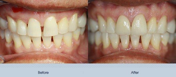 Cosmetic veneers