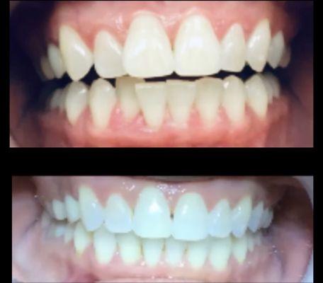 Recently completed Invisalign with teeth whitening at Walsh Dental.