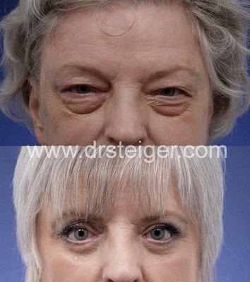 Upper and lower eyelid surgery (blepharoplasty)