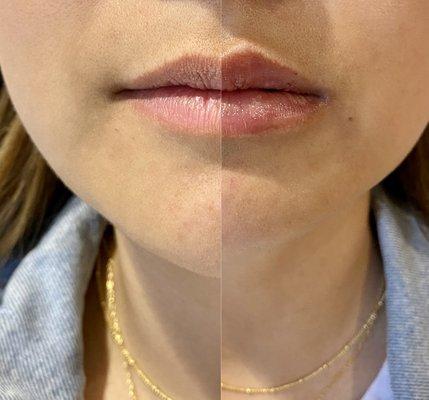 Lip filler results!