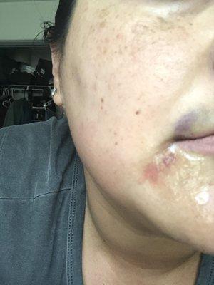 Bruising on my top lip and scabbing on the bottom