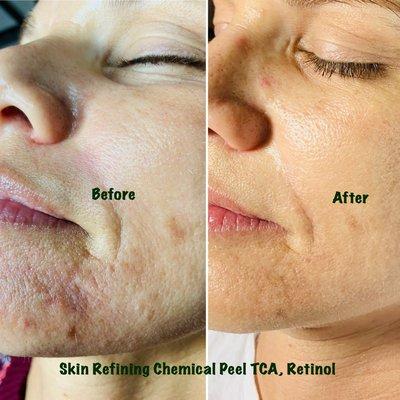 Refining Peel (TCA, Retinol)