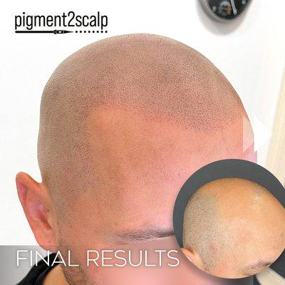 Bringing back natural looking hairlines and density that blends in with your existing flat-shaven hair follicles.