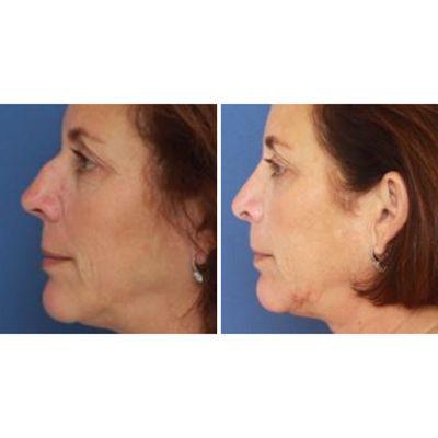 Rhinoplasty