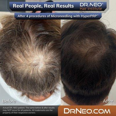 Patient underwent 4 treatments of Microneedling with HyperPRP for hair re-growth around the crown area.