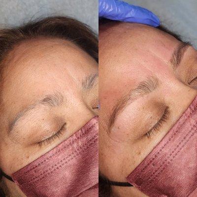 "Meat cleaver" brow correction