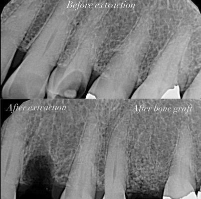 Before & After: Extraction with bone graft