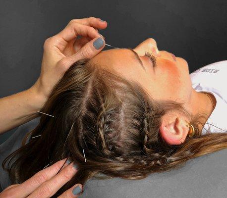 Acupuncture for stress and mental clarity.