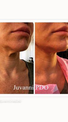 Pdo threadlift for underchin skin sagging