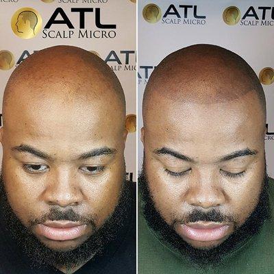 Before and after 2 sessions of scalp micropigmentation by Andre Lawrie