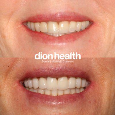 before and after of porcelain veneers