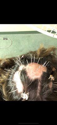 Acupuncture treatment for alopecia hairloss