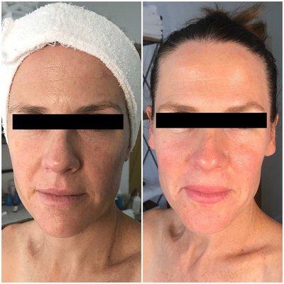 Microneedling Before and After (one week post treatment)