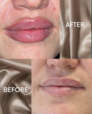 Transform your pout with Versa Lips! 
Benefits include: 
- Provides fullness, volume & hydration
- add projection and symmetry