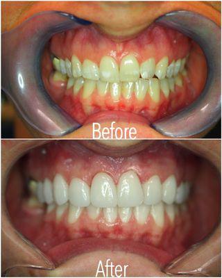 Veneers performed by Dr.Tanioka