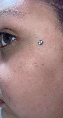 Beautifully healed dermal by Victoria