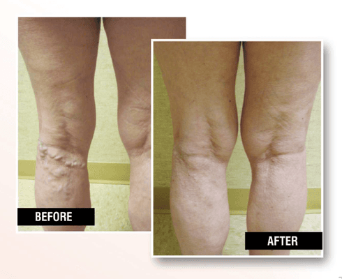 Before and after vein treatment at USA Vein Clinics