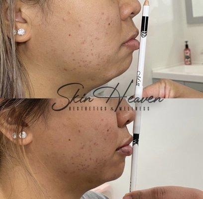 Beautiful Balance Package $1300 (Originally $750 per syringe = $1500) 2 Syringes in the Chin and Lips