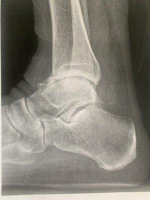 If your ankle looks like this - don't give up hope- We'll get you moving again.