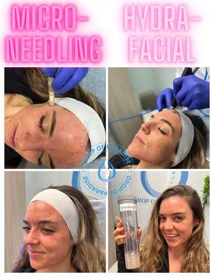 Best Combo!! Microneedling AND Hydrafacial, only $400 (original 600+) when booking min 4 sessions